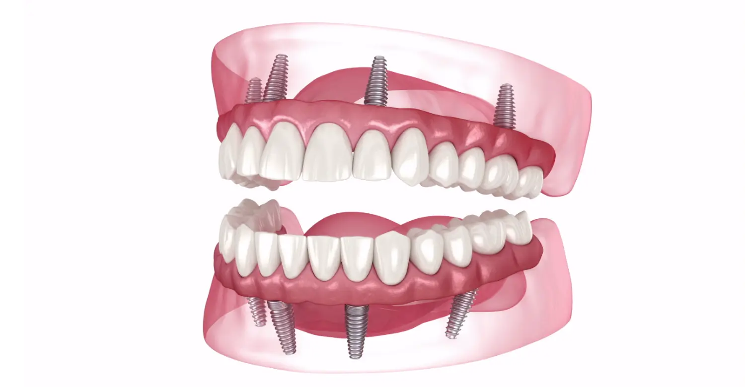 How Much to Replacing All Teeth with Implants Cost 2